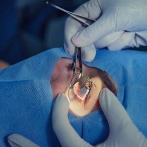 ניתוח קטרקט שאלות